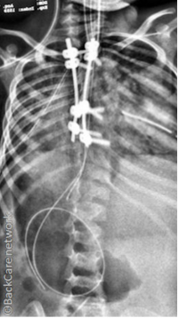 Ακτινογραφία σπονδυλικής στήλης κοριτσιού 4 ετών μετά την χειρουργική διόρθωση σκολίωσης